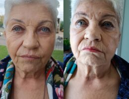 Beauty FitLine prima e dopo