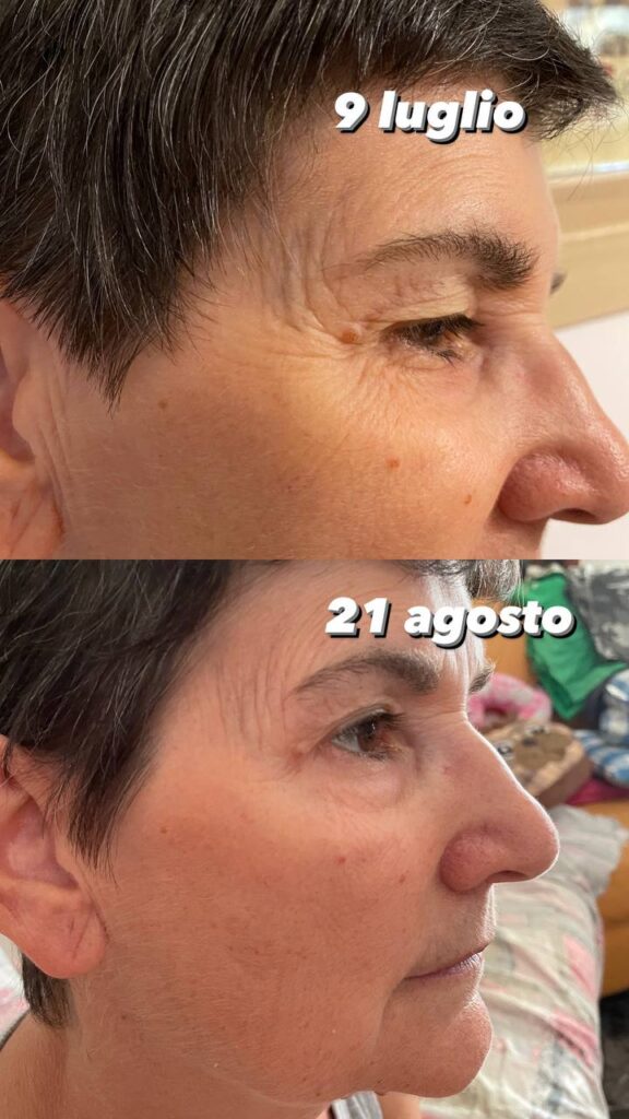 rughe prima e dopo