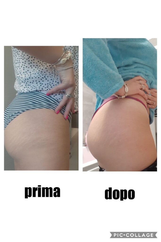 smagliature prima e dopo collagene 